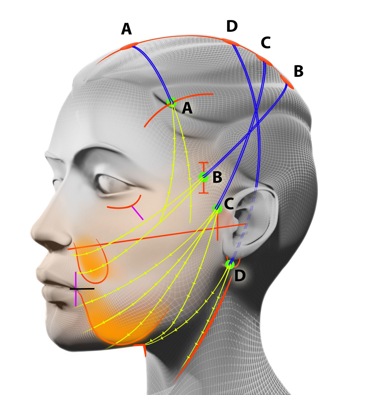 Easylift fils face